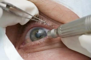medicos-alertam-para-riscos-de-cirurgia-de-mudanca-da-cor-dos-olhos